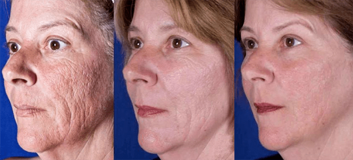 Résultat après la procédure de resurfaçage de la peau du visage au laser