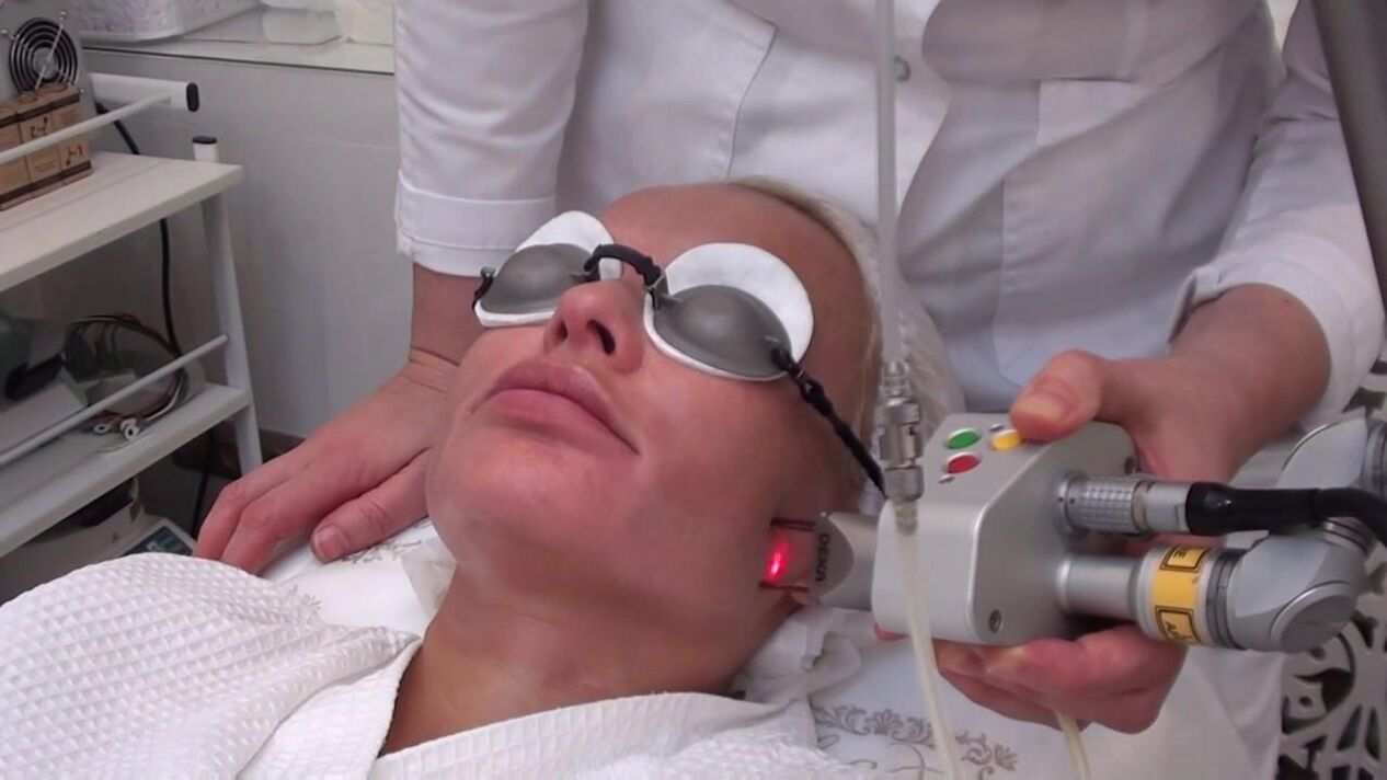 Traitement avec un faisceau laser des zones à problèmes de la peau du visage. 