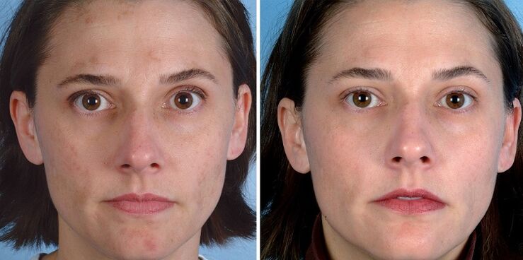 avant et après le rajeunissement de la peau avec l'appareil