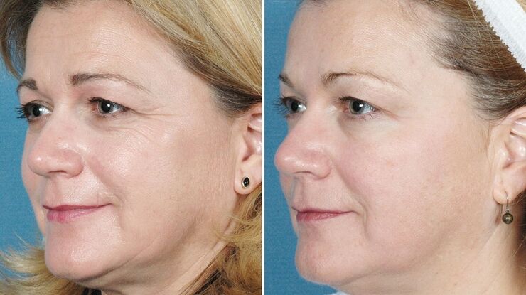 photos avant et après le rajeunissement de la peau avec du matériel